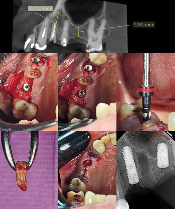 Advanced Dental Implants